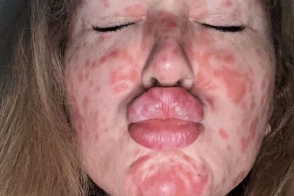 Woman Contracts Rare Measles Infection, Leading to Unexpected Pregnancy