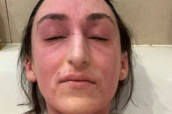 Woman Ties ‘Alien’ Skin Condition to Decades of Steroid Cream Use