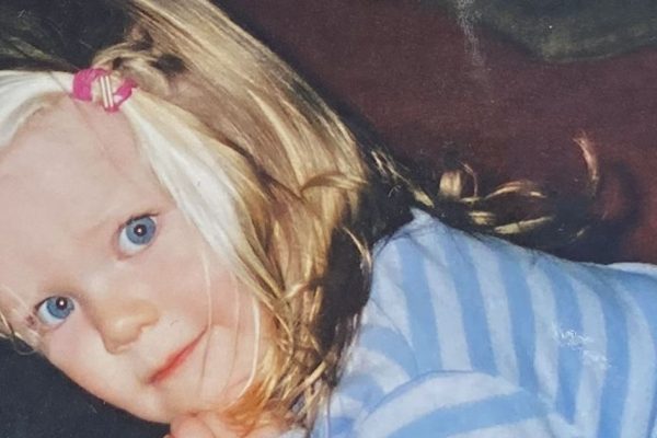 From Schoolyard Bullying to Acceptance: One Woman’s Journey with Piebaldism